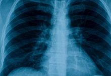 Photo of Aplicativo criado na USP identifica covid-19 a partir de raio-x do pulmão